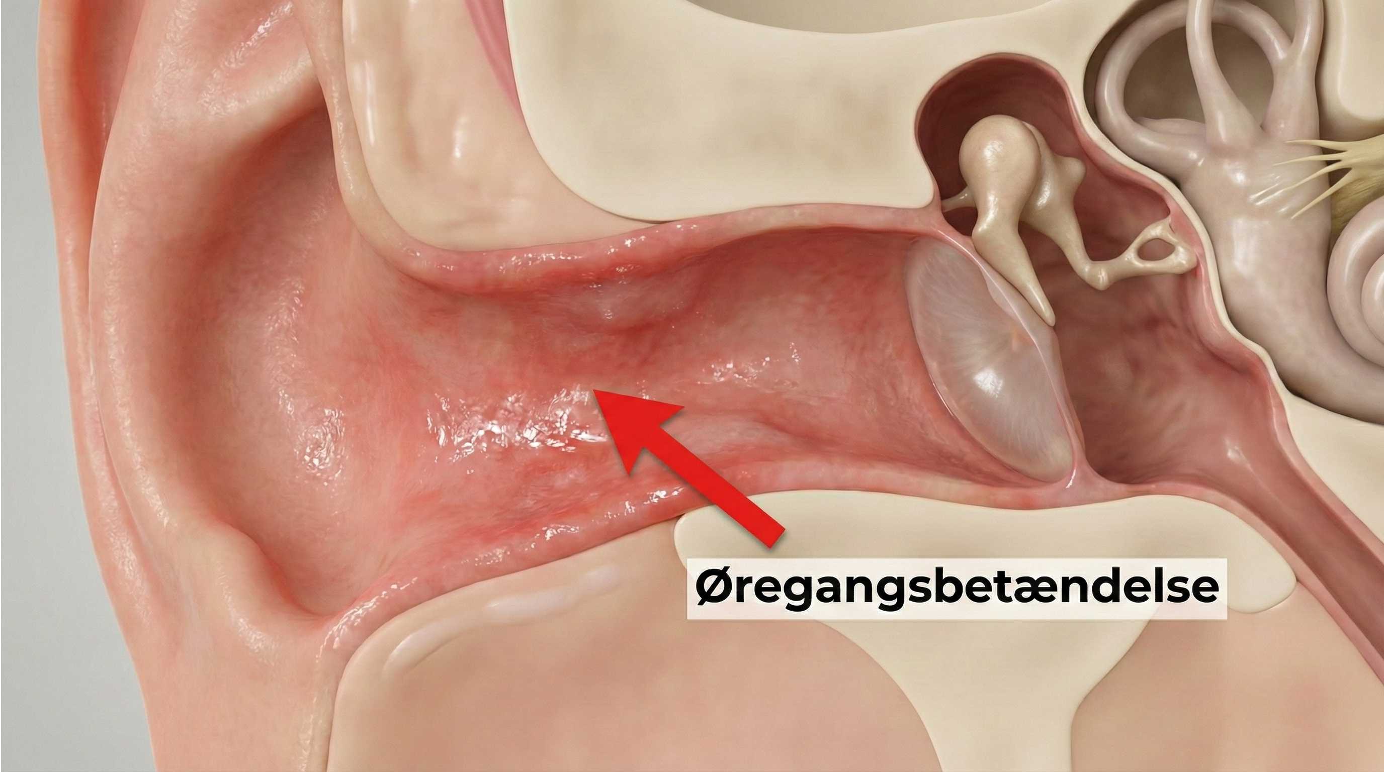 Illustration af rød og irriteret hud i øregangen ved øregangsbetændelse