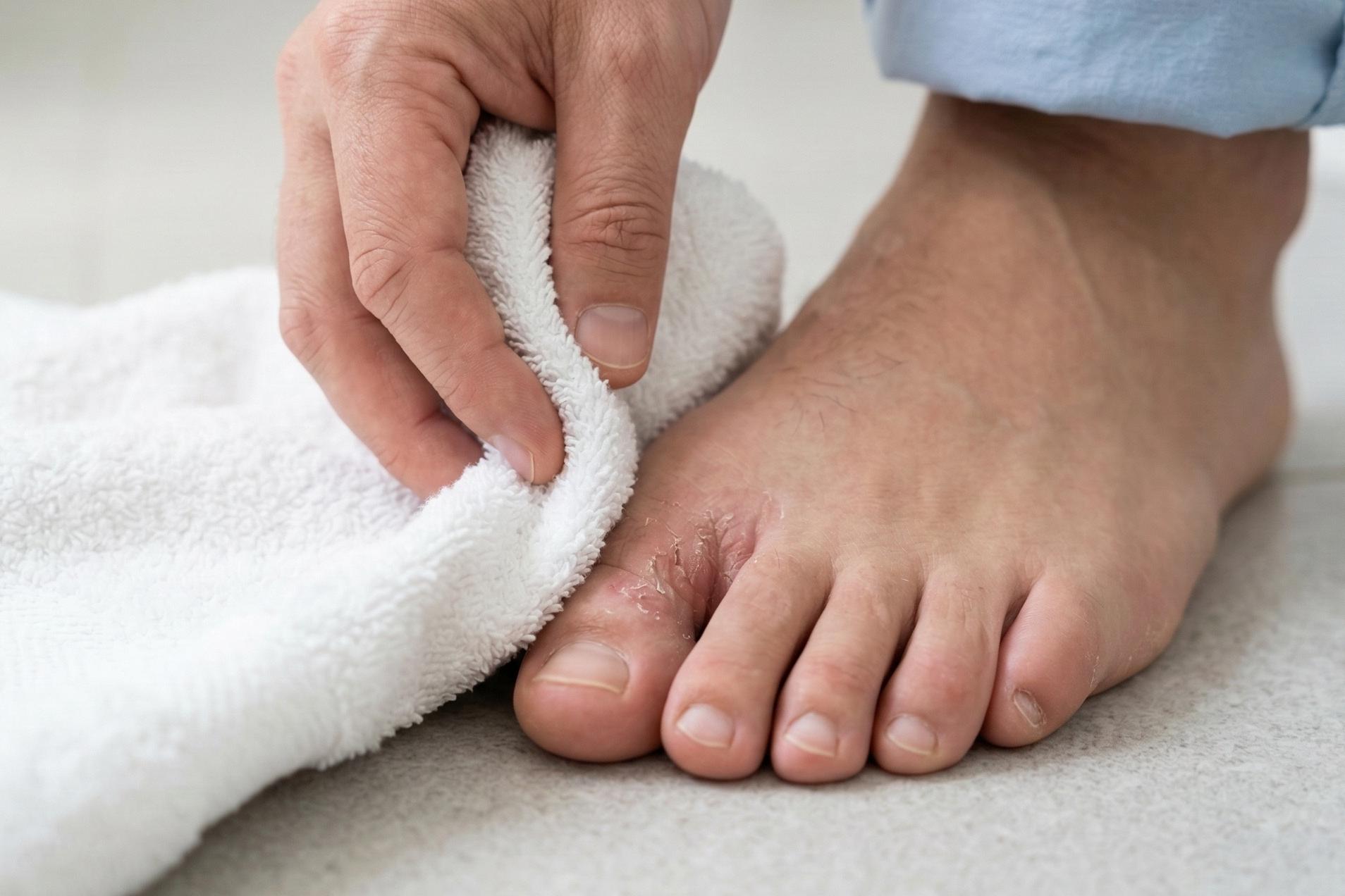 Fodsvamp mellem tæerne med let rødme og afskalning
