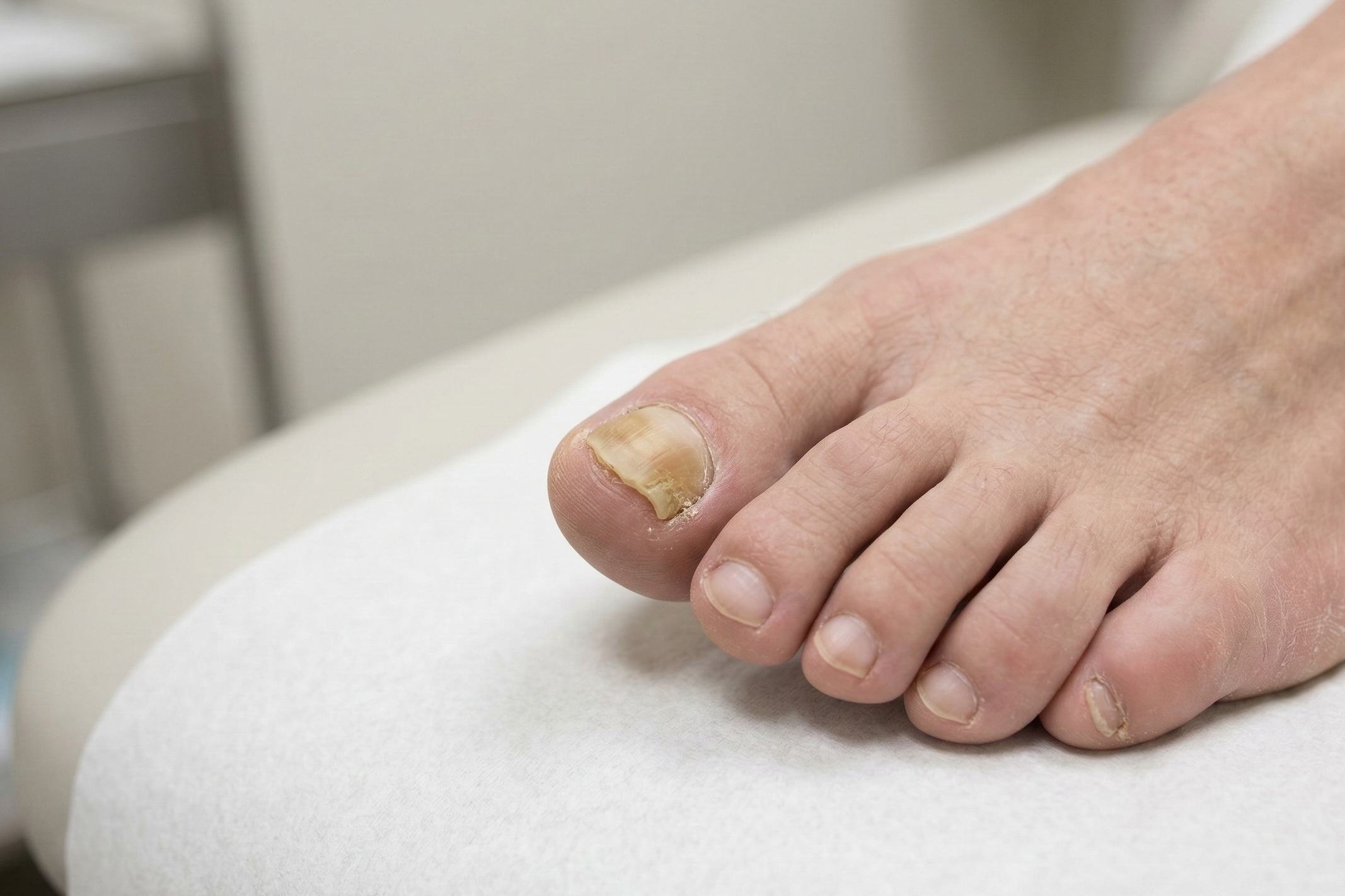 Tånegl med neglesvamp og gullig misfarvning